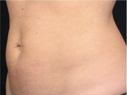 TruSculpt ID Before & After Patient #1563